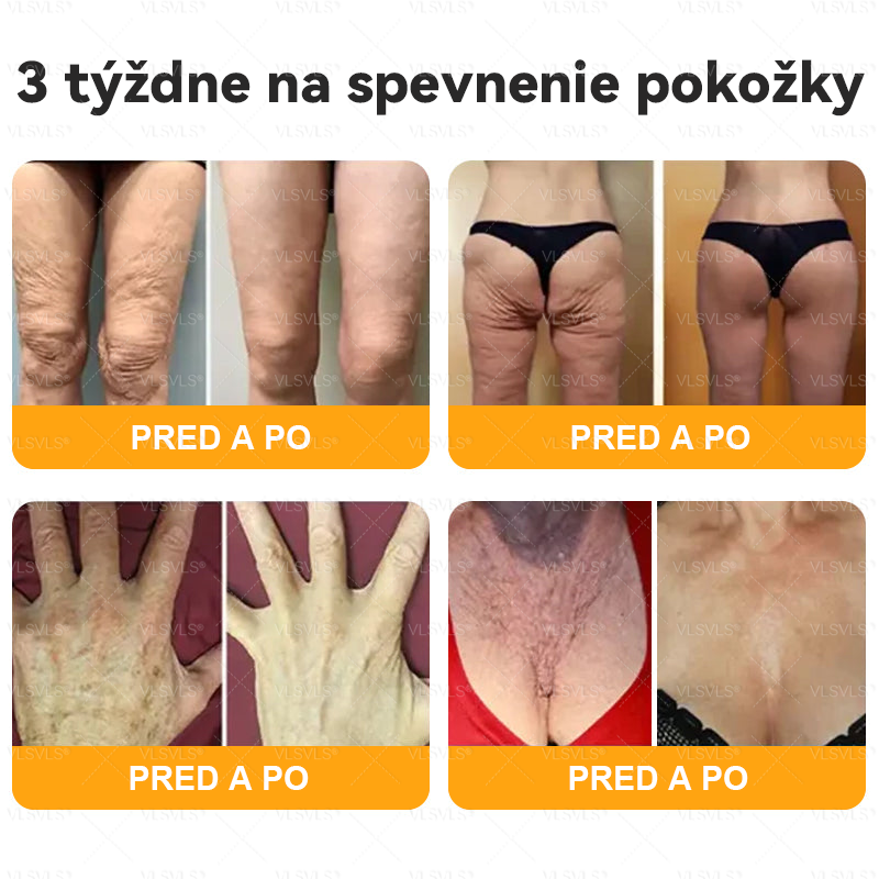 👩‍⚕️ VLSVLS® Komplexný krém s včelím jedom – POSLEDNÝ DEŇ: Zľava 80 %! (ochabnutá pokožka, jemné vrásky, strata pevnosti, ploché poprsie, ovisnuté boky a ďalšie)