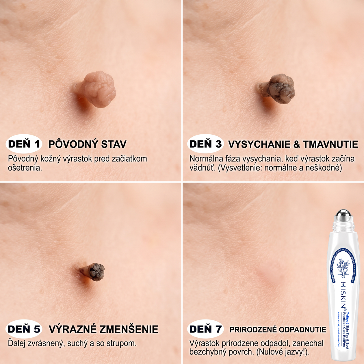 🌟HISKIN®👩‍⚕️ BOTANICKÝ – GUMA NA ŠTÍTKY A ŠKVRNY – Bezbolestná starostlivosť o pokožku bez jaziev s pokročilým guľôčkovým aplikátorom